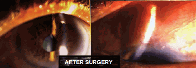Slide 14 After surgery