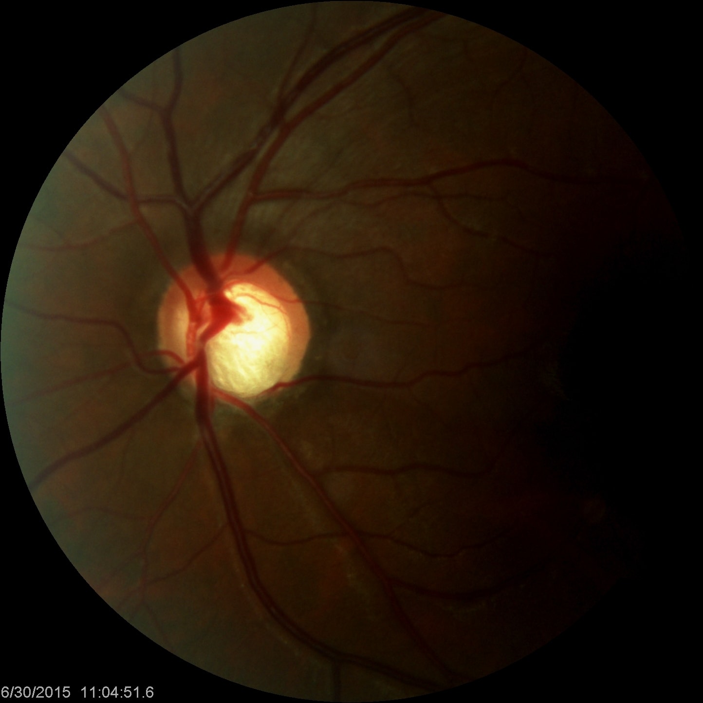 Glaucomatous Optic Nerve