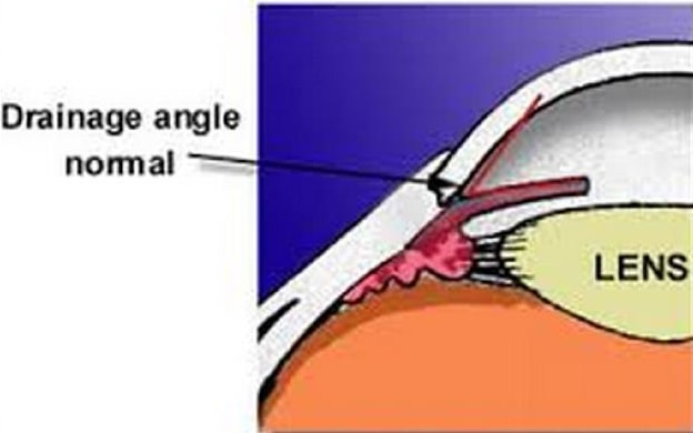 Angle in the Eye