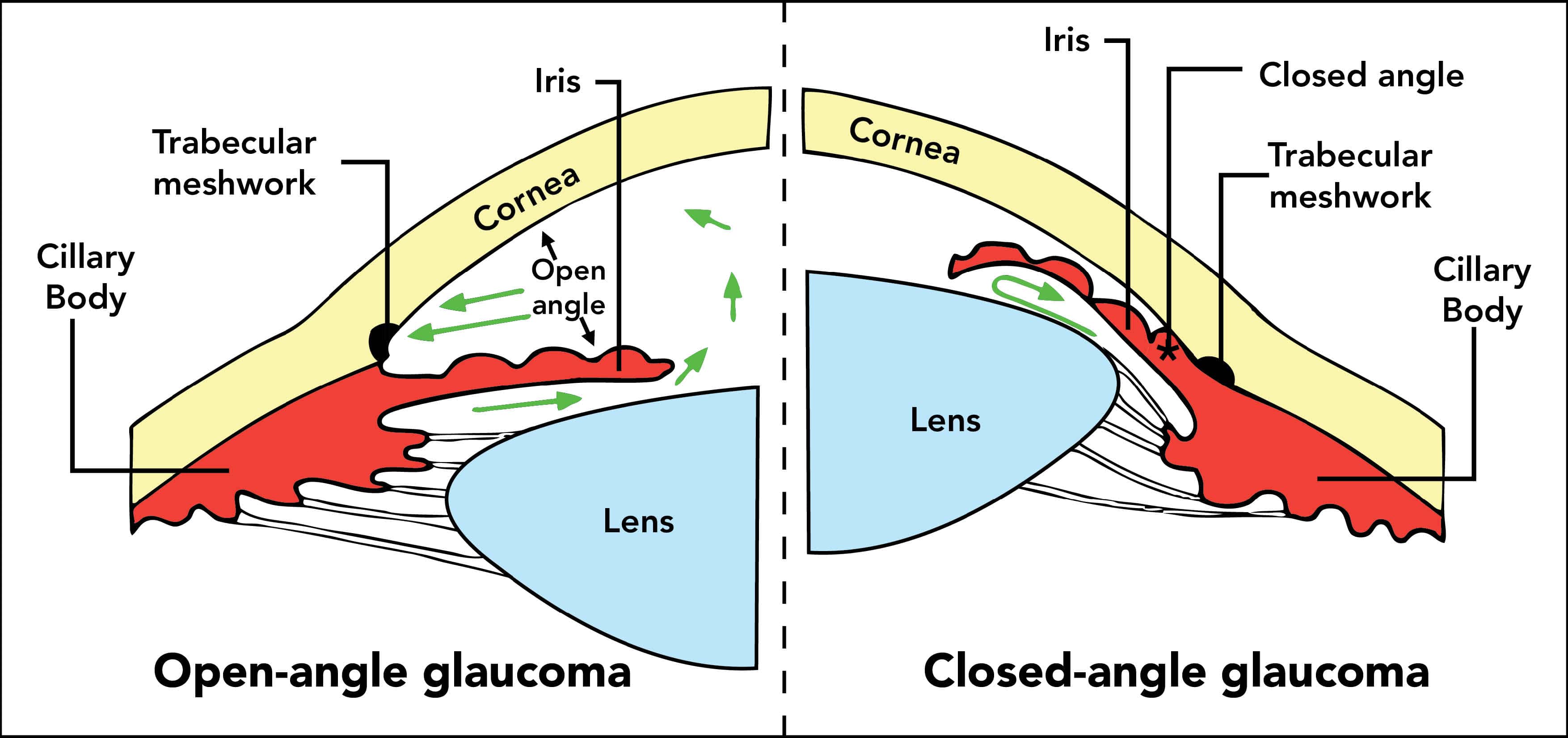 Open versus Narrow/Closed angle