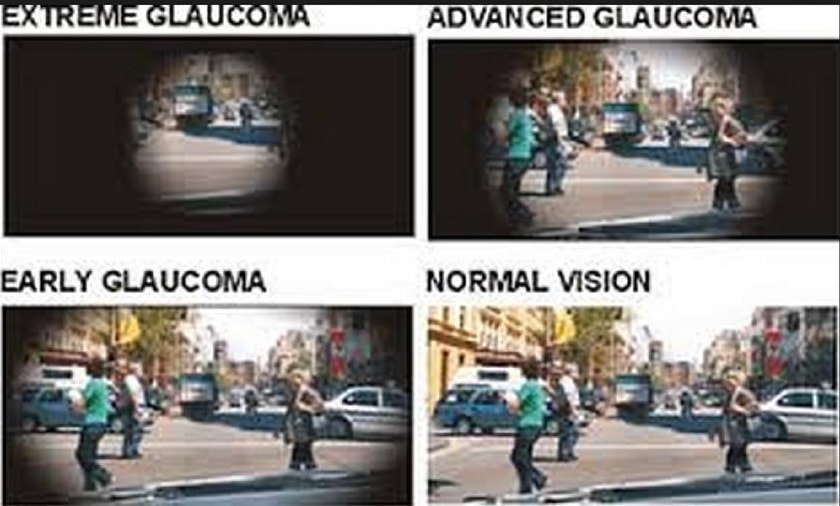 Visual Field Loss in Glaucoma