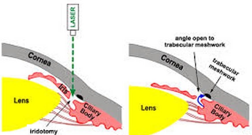 Laser iridotomy for narrow angle glaucoma