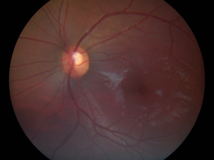 The pink disc seen in the image above is the optic nerve