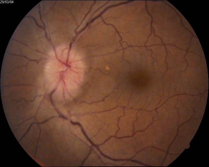 optic neuritis