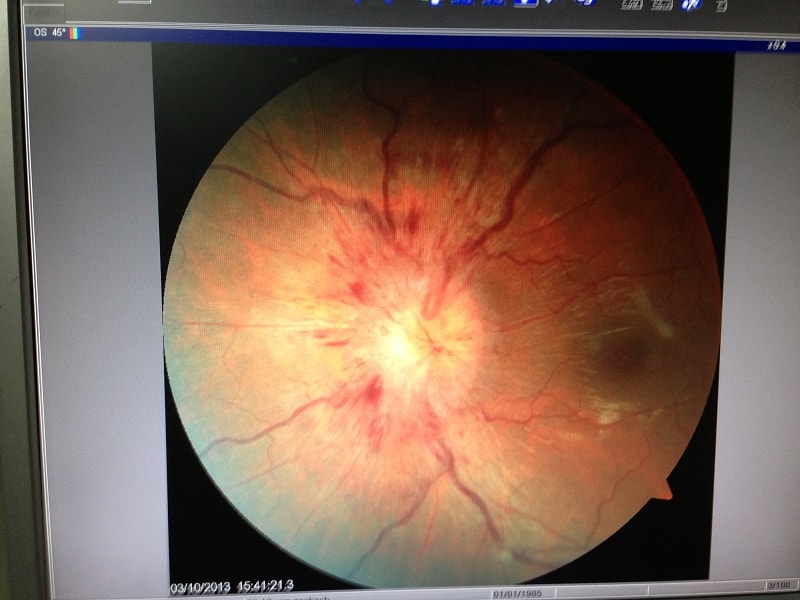 Optic Nerve Disease - Eye Specialist, Treatments, Types and Symptoms