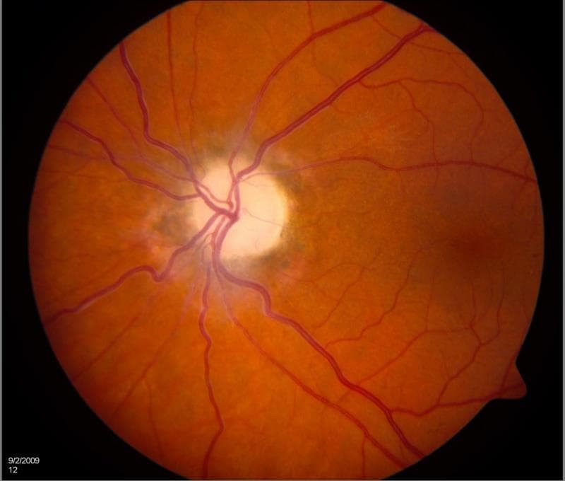 optic atrophy