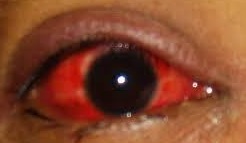 Red eye due to conjunctivitis