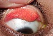 Papillae seen in a case of seasonal eye allergy