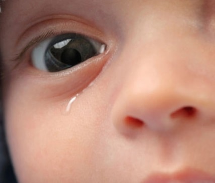 Tearing from eyes of child with nasolacrimal duct obstruction