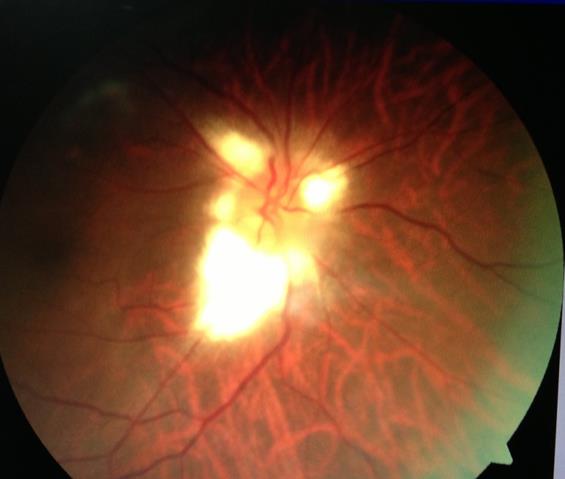 Myelinated Nerve Fibres: Note the feathery fluffy white fibres at the optic disc.