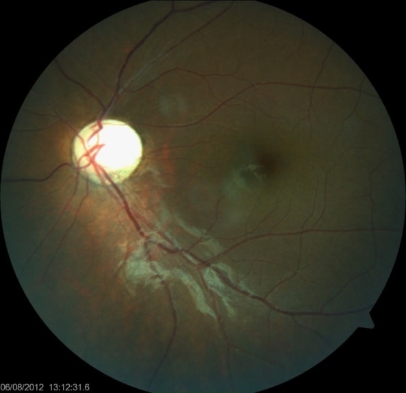 Hereditary optic atrophy. Note the yellow appearing pale disc.