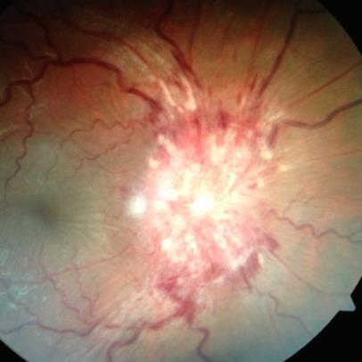 Papilledema. Note the swollen optic disc with haemorrhages and white deposits. 