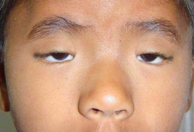 A Child with severe ptosis in both eyes