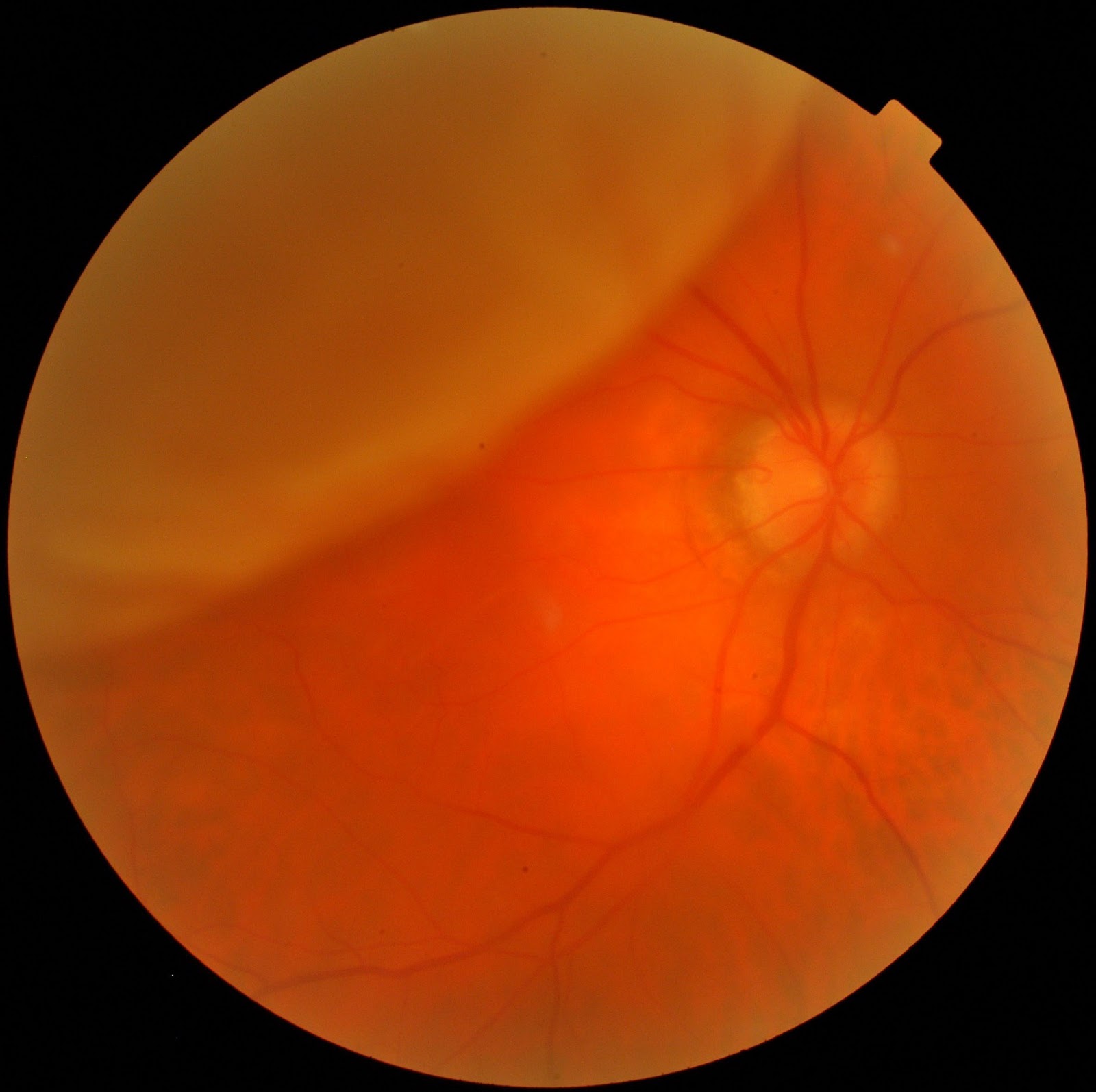 Retinal detachment seen on a fundus photograph