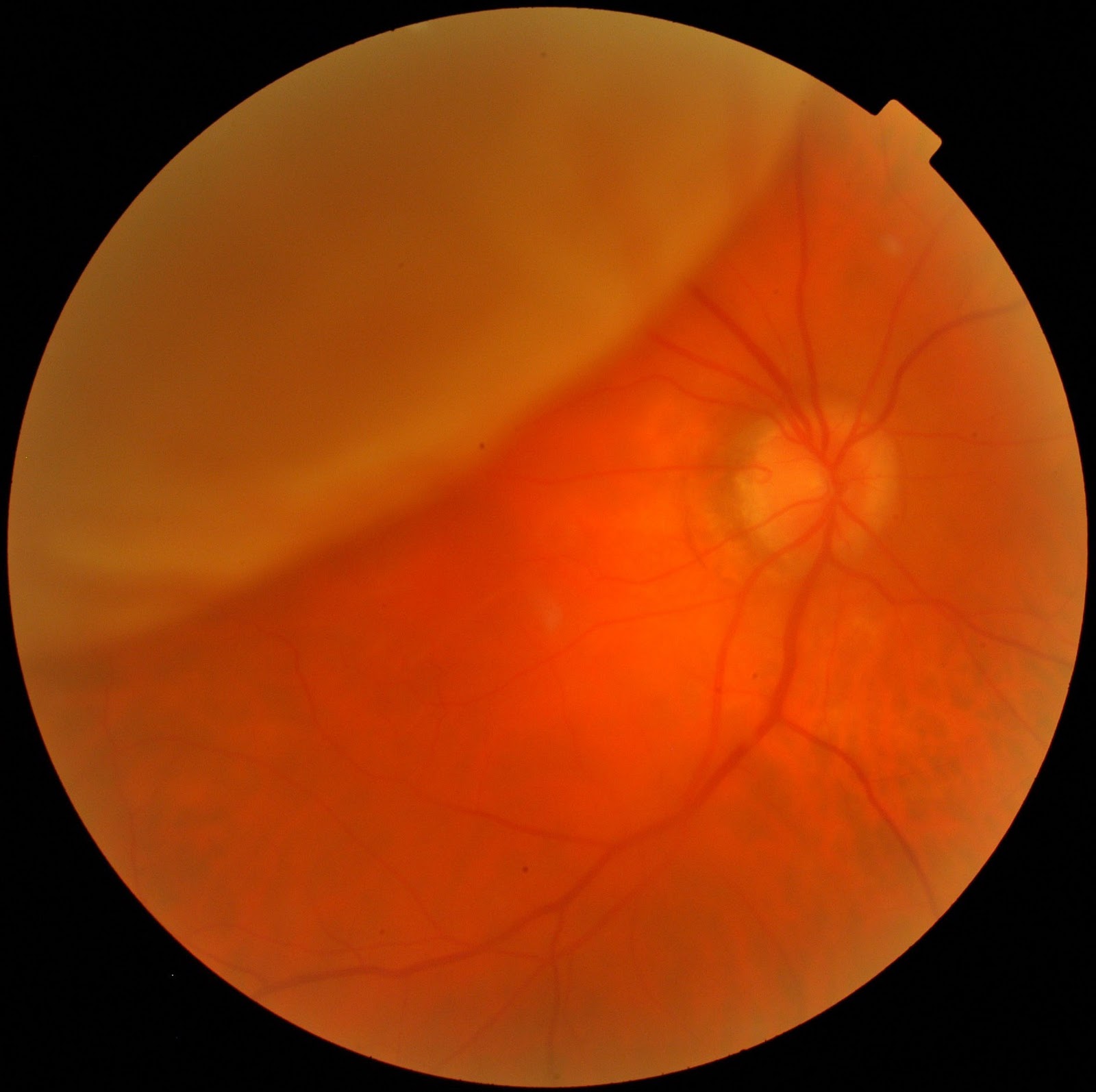 cause of torn retina