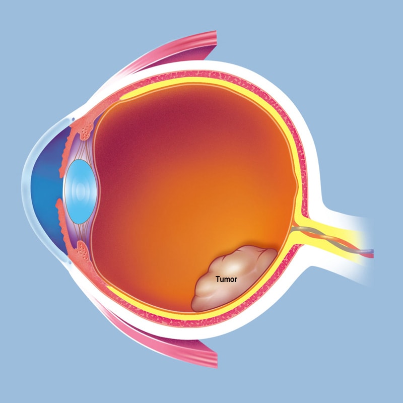 Retinoblastoma tumor