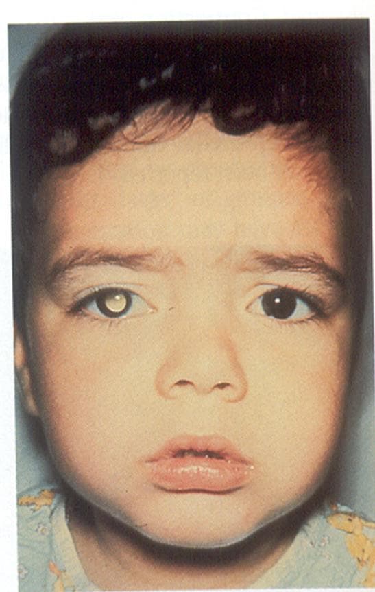 Child with Retinoblastoma