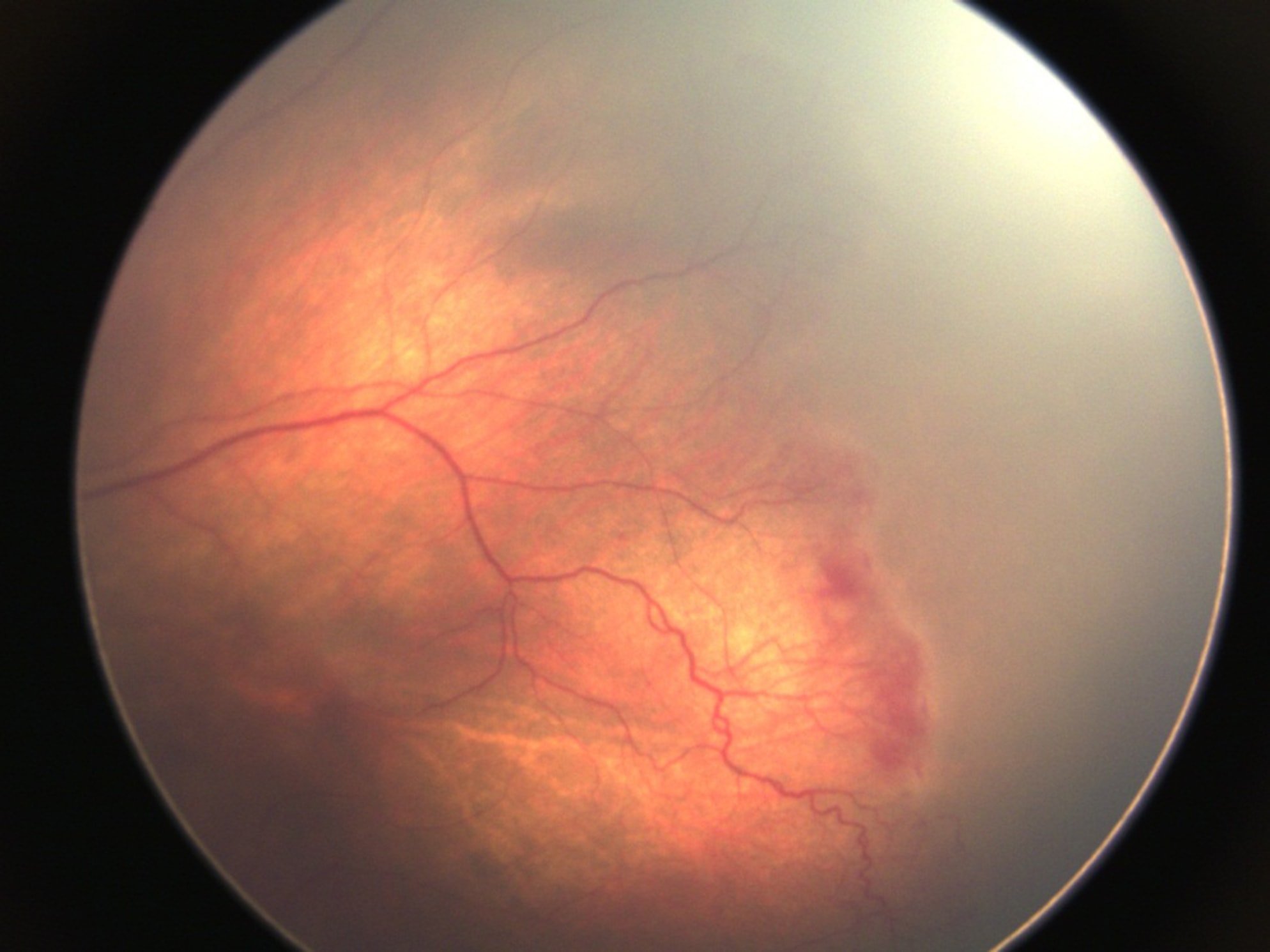 a case of retinopathy of prematurity. 
