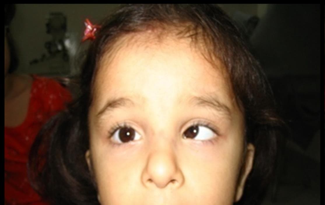 A Child with Esotropia