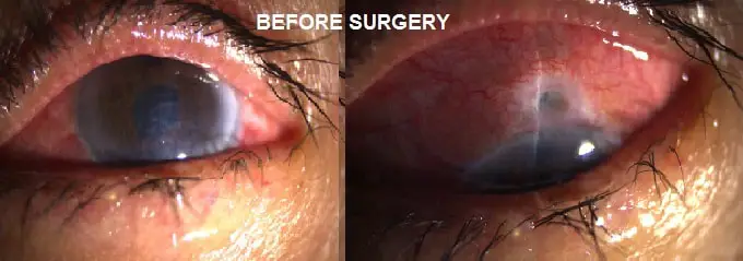 Slide-14-Before-surgery
